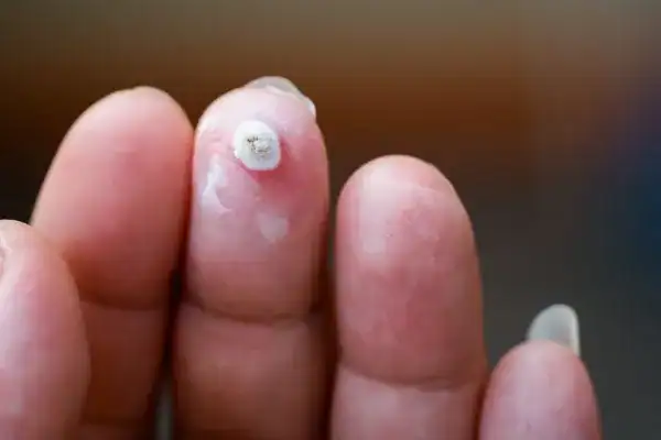 Image of white wart before cryopen treatment Hassocks