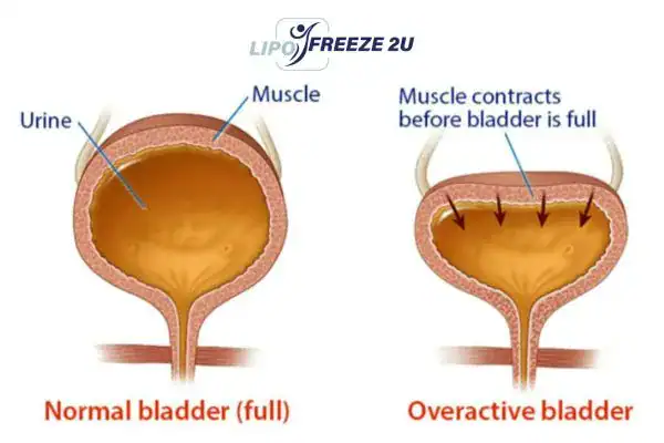 diagram of overactive bladder treatment Hassocks