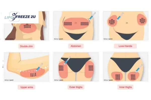 Benefits of Choosing Aqualyx for Fat Reduction Hassocks