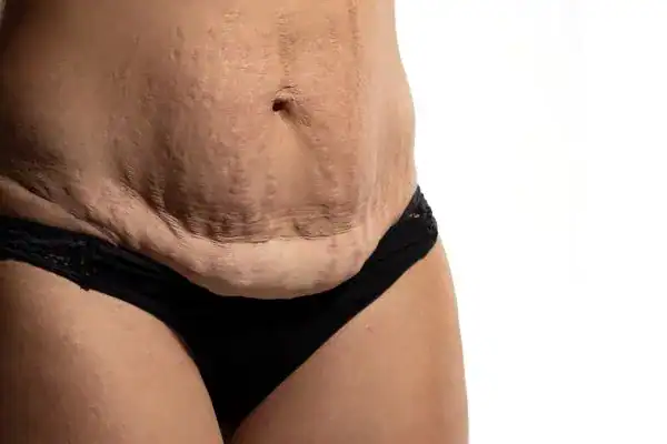 loose skin after weight loss injections Hassocks