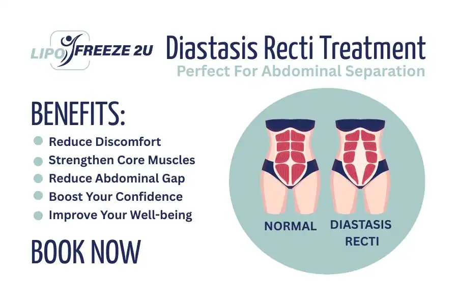 How Long Will It Take to See Improvements in Diastasis Recti Hassocks