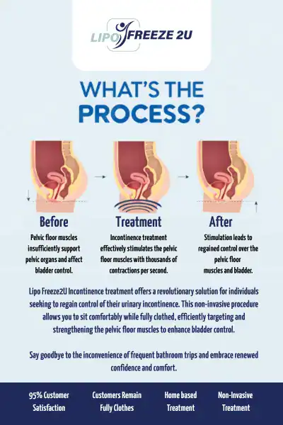 Diagram of how incontinence treatment Hassocks works.