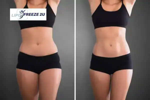 How Can LIPO FREEZE 2U Support Your Post-Pregnancy Body Recovery Hassocks?