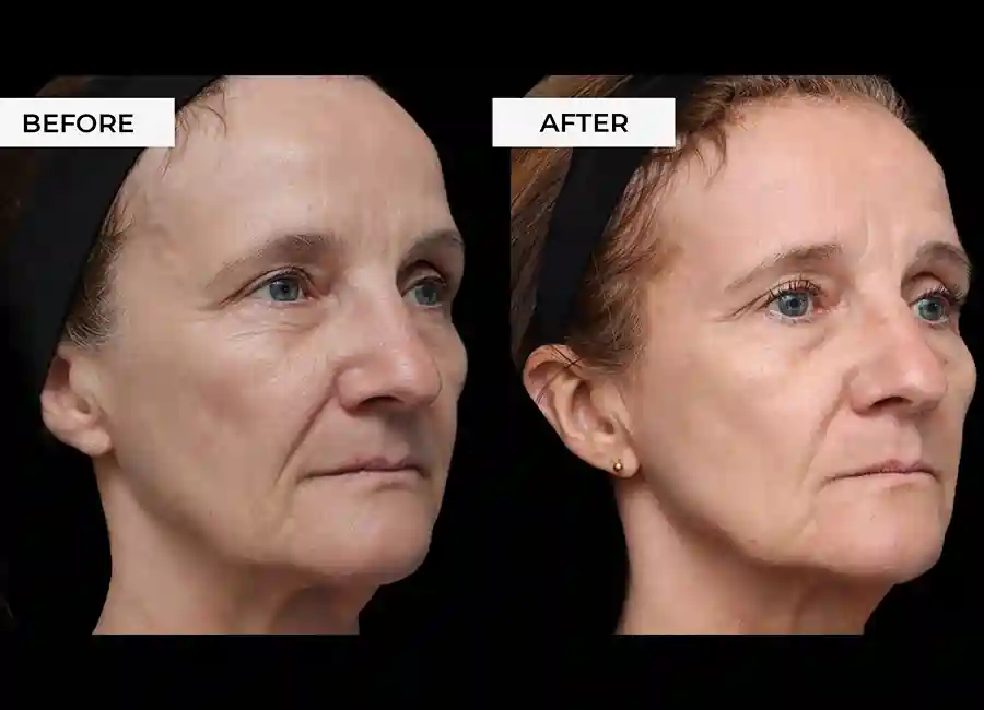 How Many RF Microneedling Sessions Will You Need to See a Difference Hassocks?