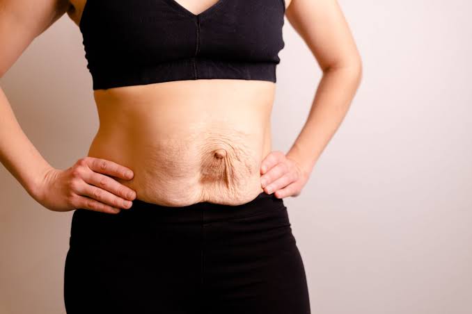 Is Surgery Really the Only Way to Repair Diastasis Recti Hassocks?