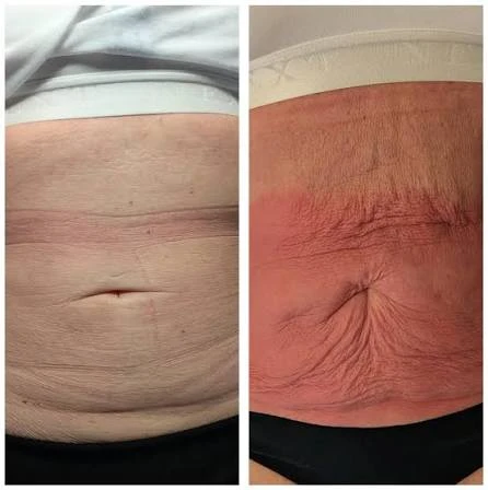How Does RF Microneedling Improve Crepey, Thin and Uneven Skin Texture Hassocks?