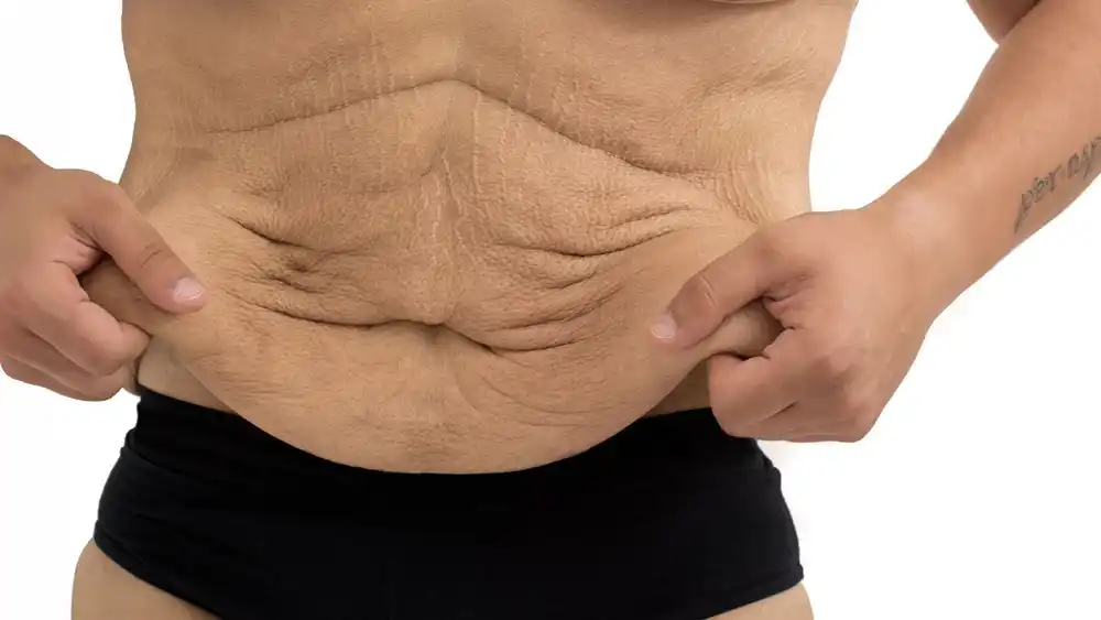 RF Microneedling for Loose Skin: How Can It Help Tighten and Reshape the Skin Hassocks?